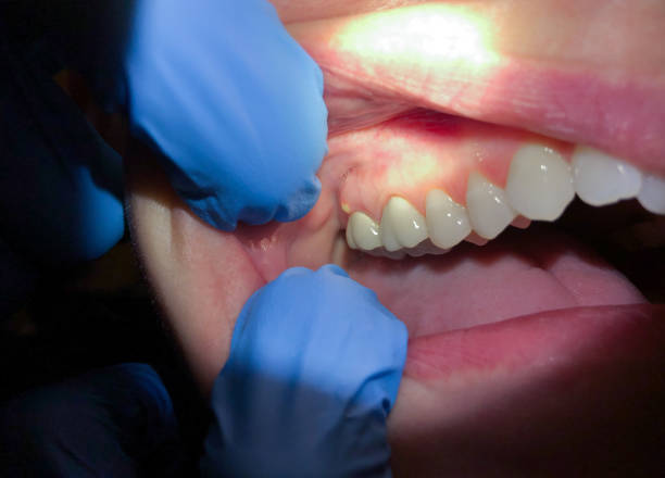 Best Emergency Wisdom Teeth Removal in Kaysville, UT